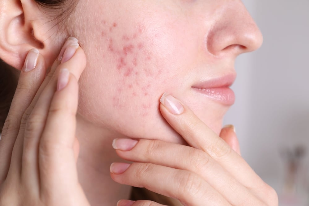 Acne & Acne Scarring